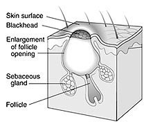 Open Comedone (Black Head) 